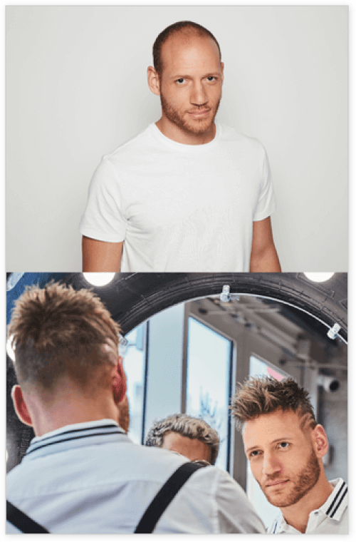 Hair Loss Prevention Services in Roswell, GA Hair Loss Prevention Services in Roswell, GA